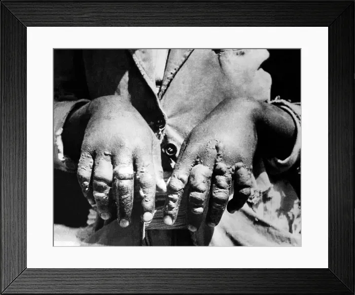 Framed Print : Second Italo-Ethiopian War. Evidence of Italian use of mustard gas used against Ethiopian forces at Dolo. Blistered hands of a victim were caused by mustard gas. Jan. 1936