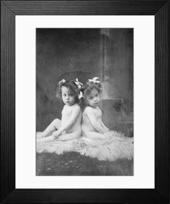Framed Print : Daisy Hilton and Violet Hilton, conjoined twins, first toured in Britain in 1911, at age 3. Mary Hilton, their mother's employer effectively bought the twins Framed Print : Daisy Hilton and Violet Hilton, conjoined twins, first toured in Britain in 1911, at age 3. Mary Hilton, their mother's employer effectively bought the twins