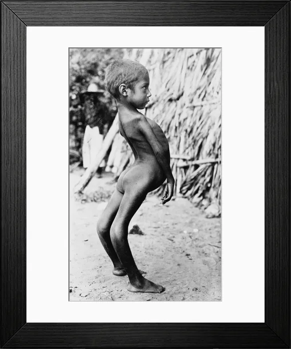 Framed Print : Deformed Mexican boy, original title: Freak Mexican Boy, Photograph by A.R. Alexander, circa 1915