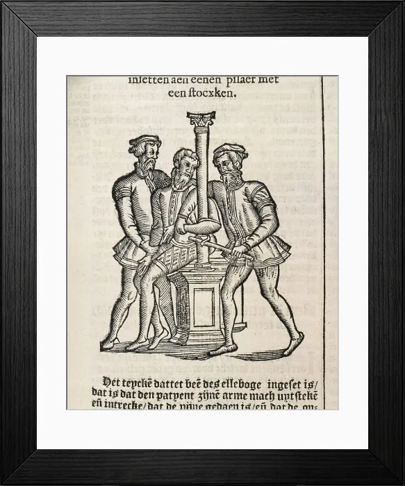 Framed Print : PARE, Ambroise (1509-1590). 'De Chirurgie' (On Surgery). Edition executed in Amsterdam (1636). Xylography. FRANCE. Paris. National Library