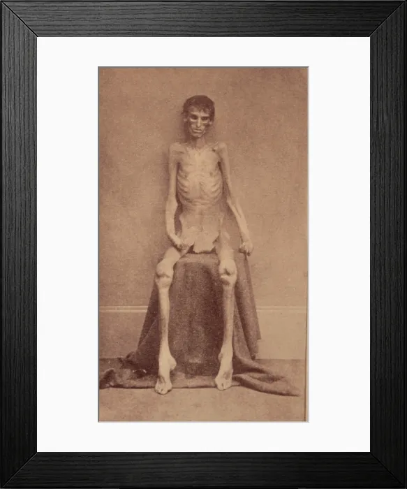 Framed Print : The Civil War, A Federal prisoner, returned from prison, full-length, seated, nude, facing front, 1861-1865