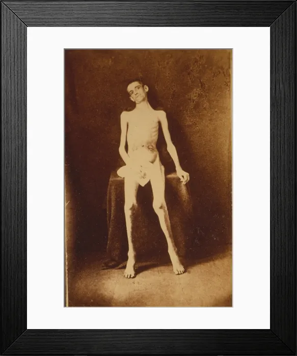 Framed Print : The Civil War, A Federal prisoner, returned from prison, standing, full-length, nude, facing front, photograph, 1861-1865