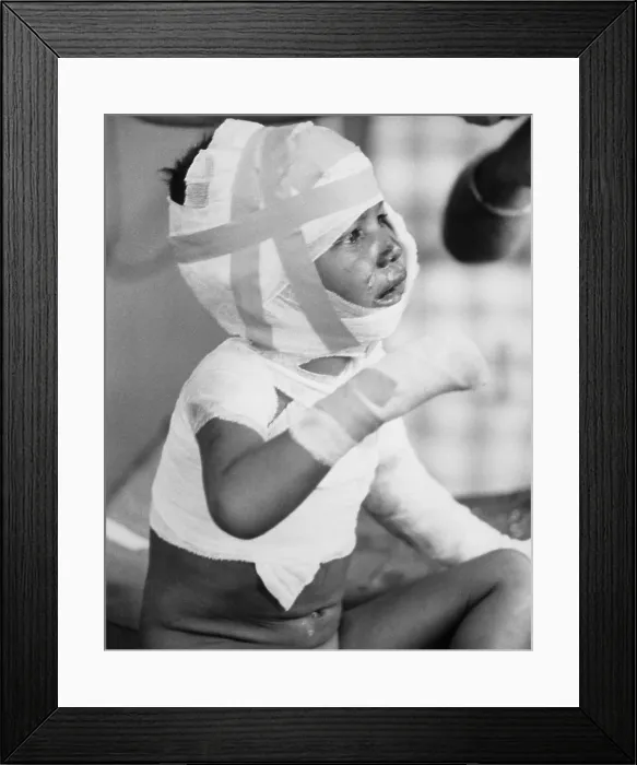 Framed Print : Young victim of Dak Son Massacre. 600 Viet Cong troops killed 252 civilians in a vengeance attack at Dak Son, home to 2, 000 Montagnards, who opposed the Viet Cong Framed Print : Young victim of Dak Son Massacre. 600 Viet Cong troops killed 252 civilians in a vengeance attack at Dak Son, home to 2, 000 Montagnards, who opposed the Viet Cong