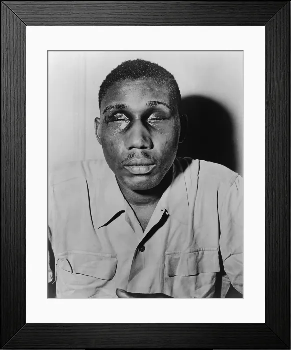 Framed Print : African American man with eyes swollen shut from beating. Ca. 1945-50