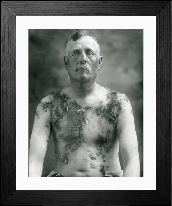 Framed Print : World War 1. John Meintz, a German-American farmer of Luverne, Minnesota, was tarred and feathered by Anti-German vigilantes on August 19, 1918