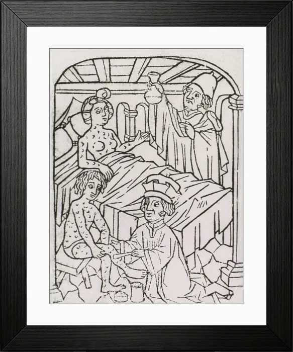 Framed Print : Syphilis In Europe. A woman in bed and a man sitting on a stool are covered with venereal disease lesions