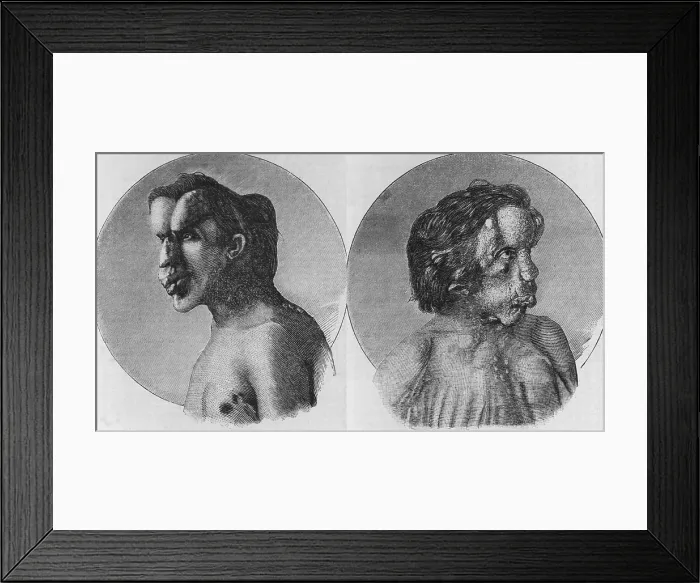 Framed Print : Joseph Merrick (1862-1890), known as the Elephant Man, suffered from Neurofibromatosis, a congenital disorder