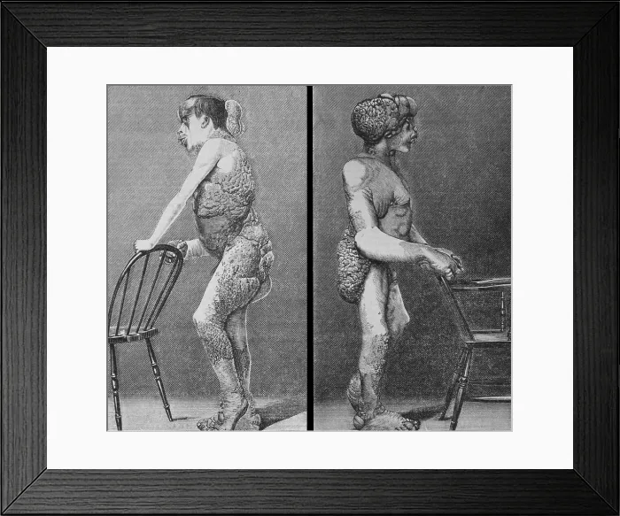 Framed Print : Joseph Merrick (1862-1890), known as the Elephant Man, suffered from Neurofibromatosis, a congenital disorder Framed Print : Joseph Merrick (1862-1890), known as the Elephant Man, suffered from Neurofibromatosis, a congenital disorder