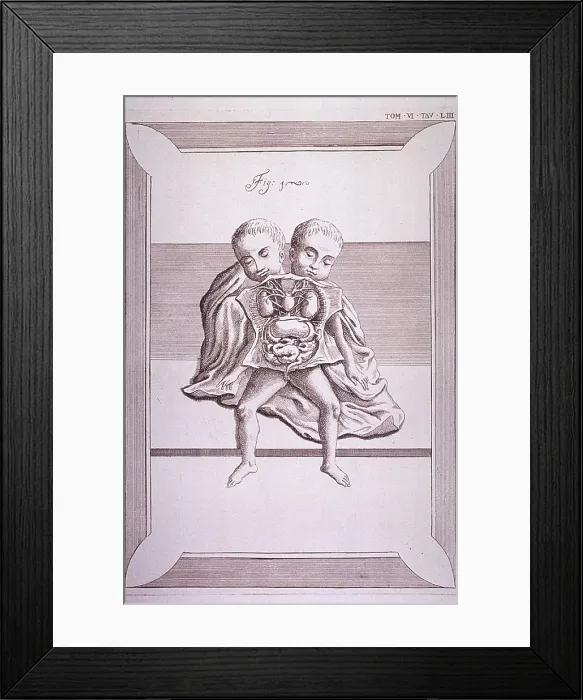 Framed Print : Conjoined twins with common torso and limbs, and the two heads. The abdomen and chest cavities are dissected open to show the organs. 18th century Italian engraving