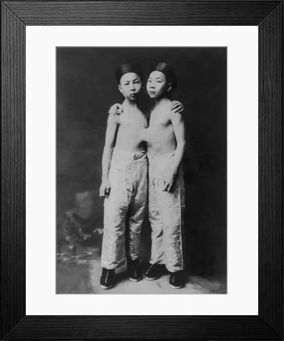 Framed Print : Korean Siamese twins standing with hands on each others shoulders. 1903 Framed Print : Korean Siamese twins standing with hands on each others shoulders. 1903