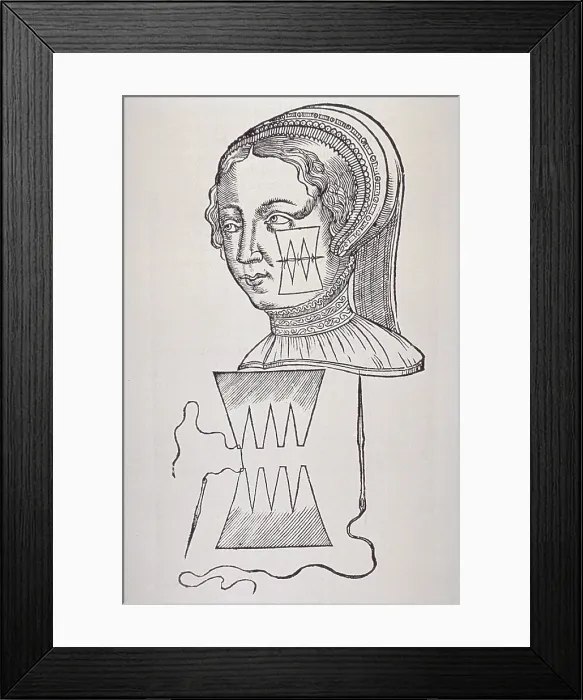 Framed Print : Illustration of suture technique that minimized scarring from a face wound of a women. From Ambroise Pare's, DIX LIVRES DE LA CHIRURGIE (TEN BOOKS ON SURGERY), 1564 Framed Print : Illustration of suture technique that minimized scarring from a face wound of a women. From Ambroise Pare's, DIX LIVRES DE LA CHIRURGIE (TEN BOOKS ON SURGERY), 1564