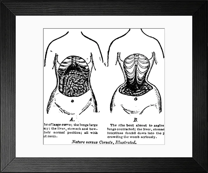 Framed Print : Nature Versus Corsets. At left is the natural arrangement of a woman's internal anatomy, contrasted with the corset's effects on the internal organs and bones Framed Print : Nature Versus Corsets. At left is the natural arrangement of a woman's internal anatomy, contrasted with the corset's effects on the internal organs and bones