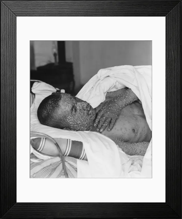 Framed Print : The heavily pockmarked face, arms and hands of a smallpox victim in Palestine, ca. 1900-1925