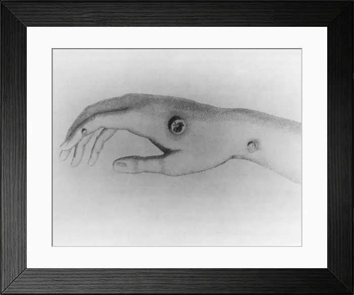 Framed Print : Cowpox pustule on the arm of milkmaid, Sarah Nelme, which Edward Jenner used as a source for his smallpox vaccine Framed Print : Cowpox pustule on the arm of milkmaid, Sarah Nelme, which Edward Jenner used as a source for his smallpox vaccine