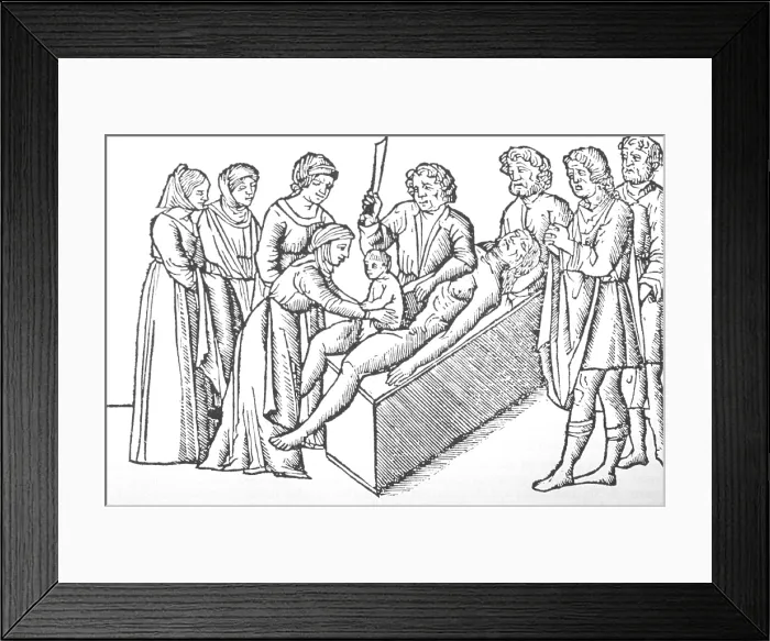 Framed Print : Illustration of the birth of Julius Caesar, by Cesarean section from a 1506 edition of Suetonius, THE TWELVE CESARS Framed Print : Illustration of the birth of Julius Caesar, by Cesarean section from a 1506 edition of Suetonius, THE TWELVE CESARS