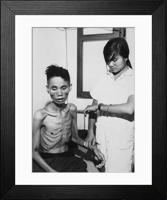 Framed Print : Victim of Viet Cong starvation. 23-year-old former Viet Cong defector to South Viet Nam, was deliberately starved when recaptured Viet Cong. Ca. 1965-1968
