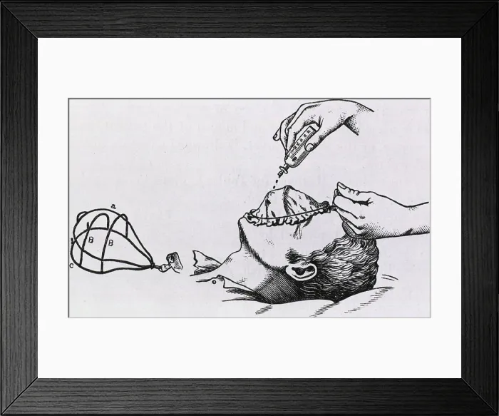 Framed Print : Wire frame supports a muslin cloth cover placed over the patient's face while drops of chloroform are dripped on the cloth. The wire frame without cover is shown on the left