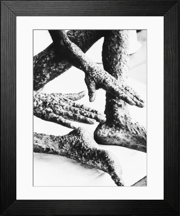 Framed Print : The heavily pockmarked hands, legs, and feet of a smallpox victim in Ivory Coast, Africa, ca. 1960