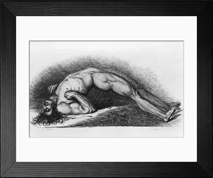 Framed Print : Tetanus (Lockjaw) victim. The contracted body of soldier suffering from tetanus. Engraving from painting by Charles Bell, 1809