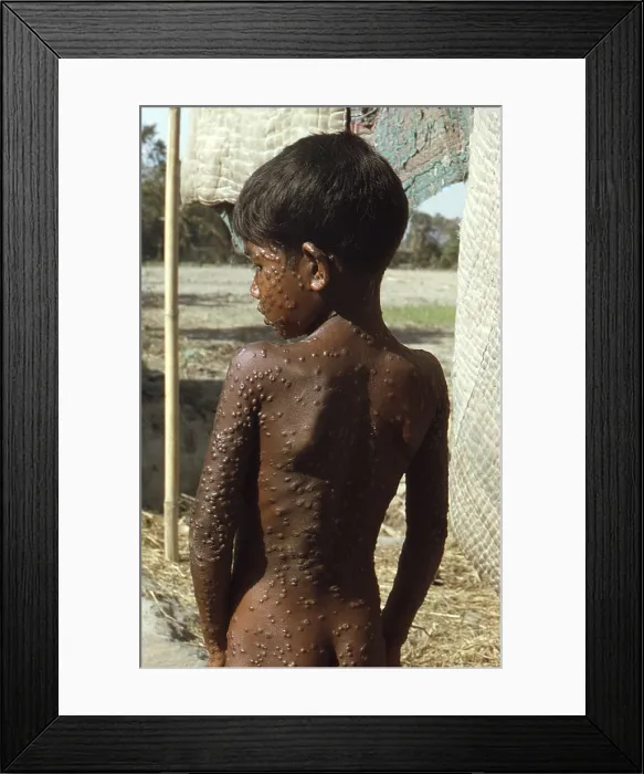 Framed Print : Bangladeshi youth with Smallpox in 1974, has the typical rash covering his entire body with pustules. The last naturally occurring case in the world was in Somalia in 1977 Framed Print : Bangladeshi youth with Smallpox in 1974, has the typical rash covering his entire body with pustules. The last naturally occurring case in the world was in Somalia in 1977