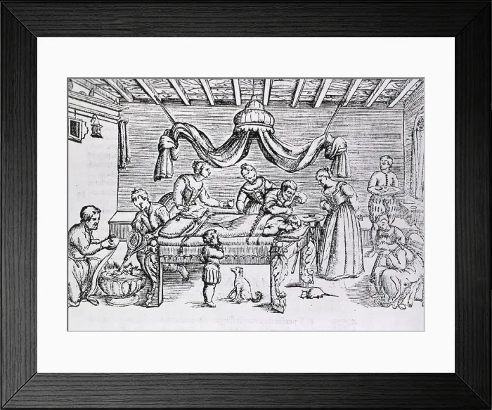 Framed Print : Brain surgery in the 16th century. A surgeon bores a hole in the patient's skull while several assistants perform various tasks