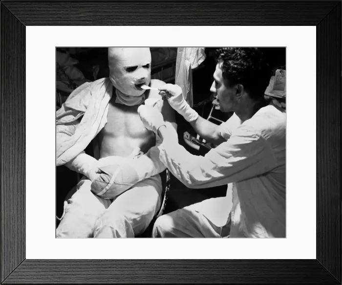 Framed Print : U.S. sailor dressed in pressure bandages after suffering burns during a Kamikaze attack. He is being fed aboard the hospital ship, USS SOLACE in 1945, during World War 2