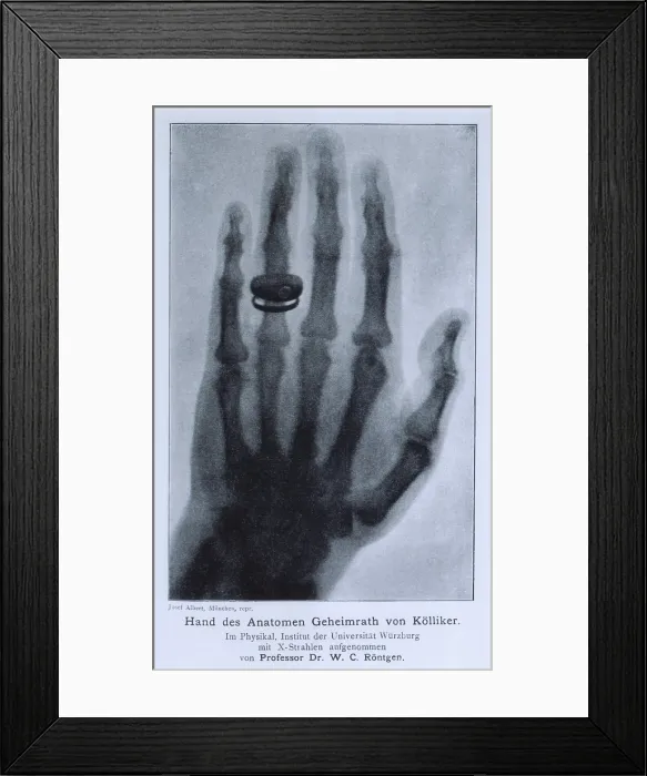 Framed Print : Konrad Roentgen's X-ray of the hand of Professor Albert von Kolliker, showing bones and the ring he was wearing