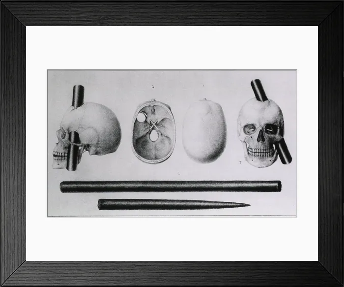 Framed Print : Various views of the famous wound in the skull of Phineas Gage, (1823-1860), showing wound made by iron rod and the rod itself