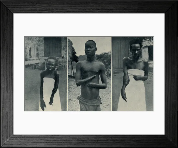 Framed Print : Atrocities of the Rubber Slavery in the Belgian Congo