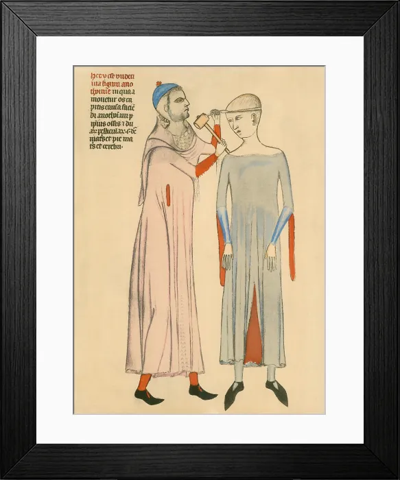Framed Print : Medieval doctor cutting open a patient's skull with a hammer and blade. Illustration from a 14th century French medical manuscript by Guy of Pavia