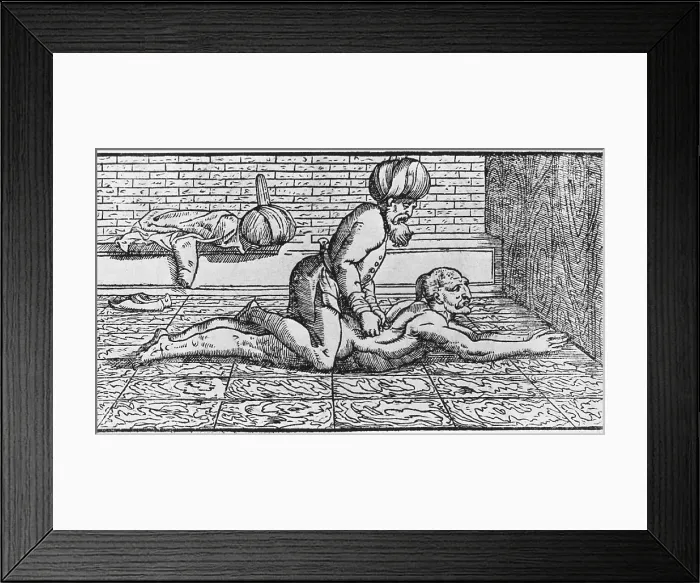 Framed Print : Doctor massaging a patient's back. Illustration from a European book, based on writings of Arab physician Avicenna (980?-1037) Framed Print : Doctor massaging a patient's back. Illustration from a European book, based on writings of Arab physician Avicenna (980?-1037)