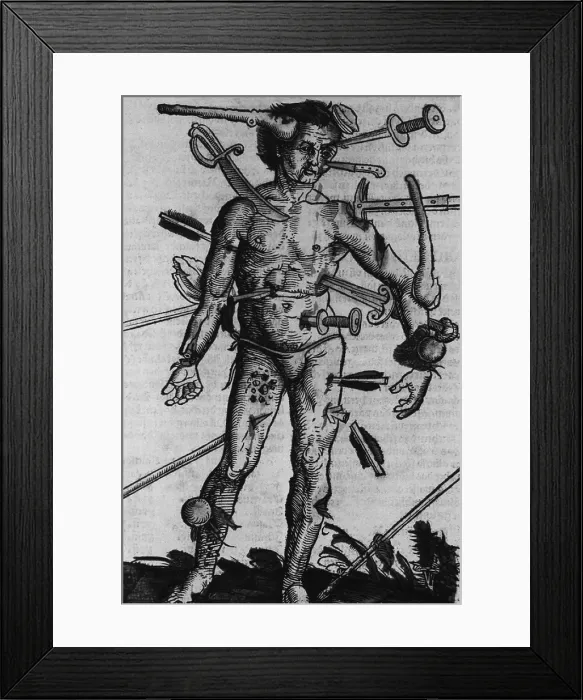 Framed Print : WOUND MAN. A man with wounds from many different kinds of weapons from a field manual for military surgeons Framed Print : WOUND MAN. A man with wounds from many different kinds of weapons from a field manual for military surgeons