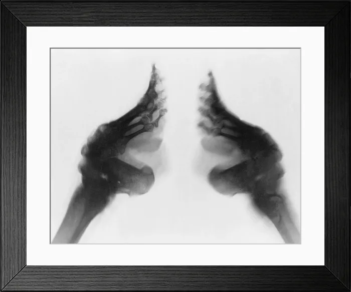 Framed Print : X-ray of a woman's bound feet, China. Ca. 1890-1923