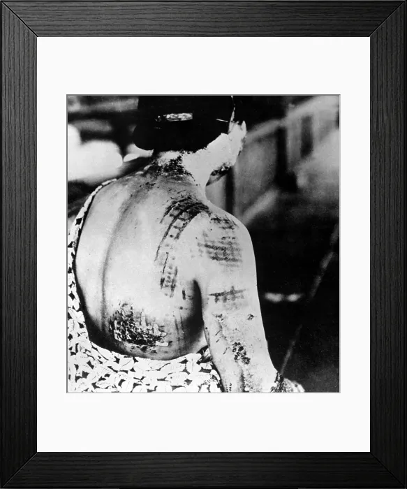 Framed Print : Injured female survivor's of Nagasaki, Japan, atomic bombing. Her skin is burned in a pattern corresponding to the dark portions of a kimono worn at the time of the explosion