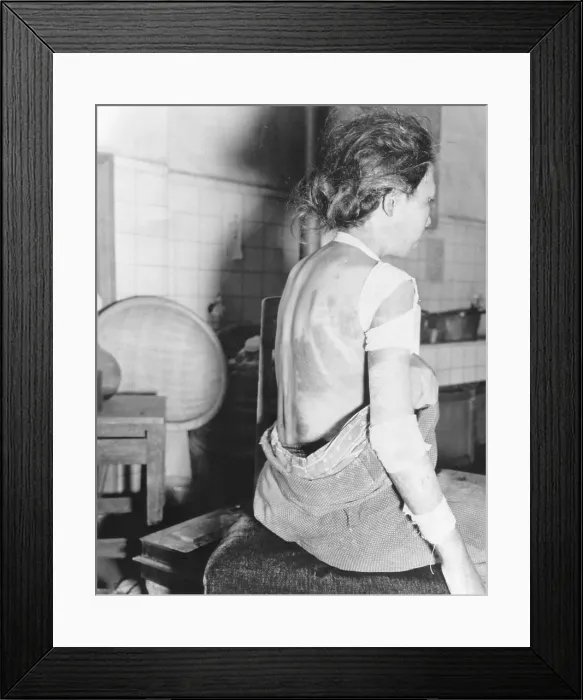 Framed Print : Japanese female victim of atom bomb. The patient's skin was burned through the kimono she wore at the time of the explosion. Japan. Sept-Dec. 1945 (BSLOC_2014_6_96) Framed Print : Japanese female victim of atom bomb. The patient's skin was burned through the kimono she wore at the time of the explosion. Japan. Sept-Dec. 1945 (BSLOC_2014_6_96)