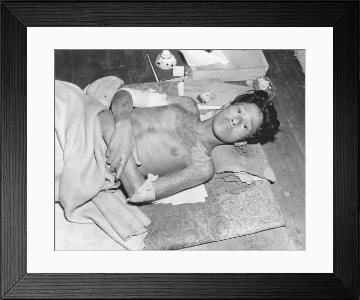 Framed Print : Japanese male victim of the atom bomb explosion over Nagasaki, Japan. Sept.-Dec. 1945. (BSLOC_2014_6_95)