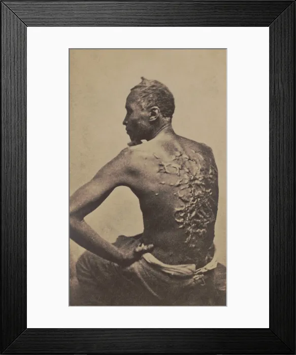 Framed Print : Escaped slave Gordon, showing his scarred back at a medical examination, Baton Rouge, Louisiana Framed Print : Escaped slave Gordon, showing his scarred back at a medical examination, Baton Rouge, Louisiana