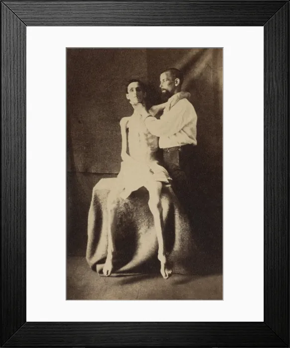 Framed Print : This emaciated Union soldier was released from Belle Isle POW prison in Richmond, during the US Civil War. Photo was taken while he received treatment at the U.S