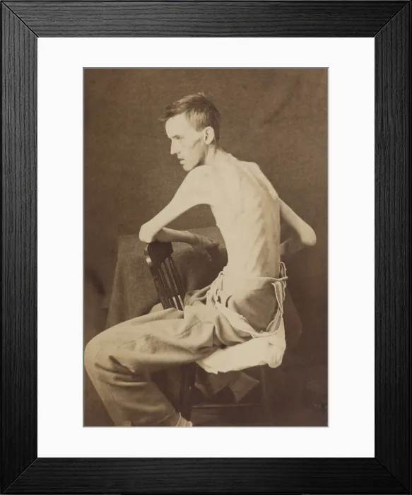 Framed Print : Union Private Jackson O. Brashears, as he appeared upon release from Confederate Belle Isle POW prison in Richmond, March 1864 Framed Print : Union Private Jackson O. Brashears, as he appeared upon release from Confederate Belle Isle POW prison in Richmond, March 1864