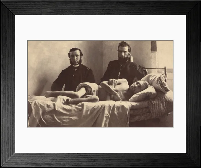 Framed Print : Corporal Calvin Bates of Co. E, 20th Maine Infantry Regiment, lies in a hospital bed after the amputation of his gangrenous feet