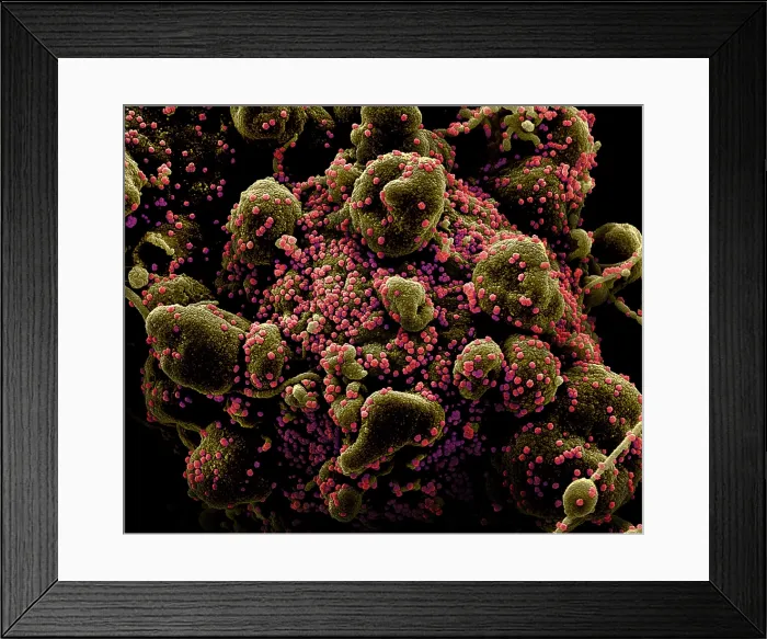Framed Print : VERO E6 cell (blue) heavily infected with SARS-COV-2 virus particles (orange), isolated from a patient sample Framed Print : VERO E6 cell (blue) heavily infected with SARS-COV-2 virus particles (orange), isolated from a patient sample