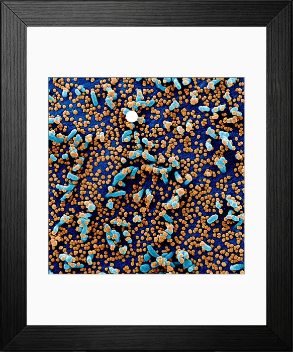 Framed Print : Apoptotic cell (blue) infected with SARS-COV-2 virus particles (red), isolated from a patient sample Framed Print : Apoptotic cell (blue) infected with SARS-COV-2 virus particles (red), isolated from a patient sample