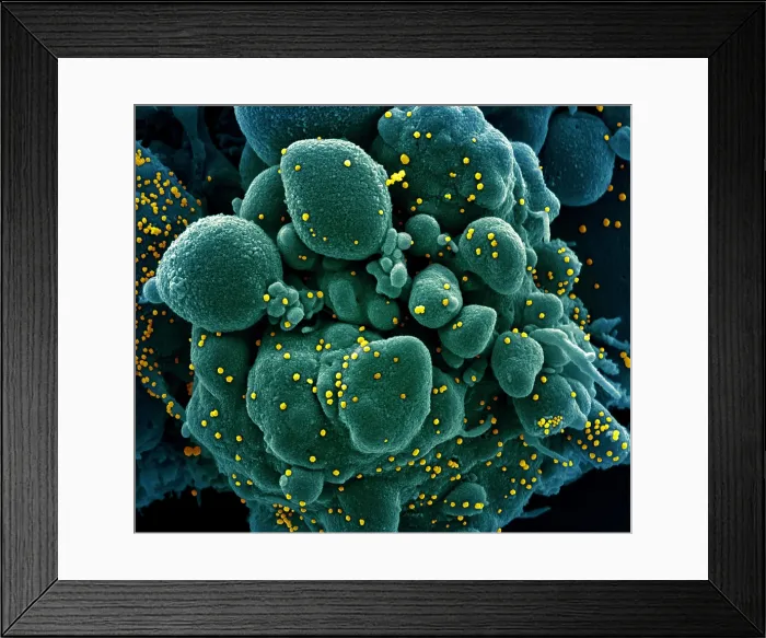 Framed Print : Apoptotic cell (greenish brown) heavily infected with SARS-COV-2 virus particles (pink), isolated from a patient sample