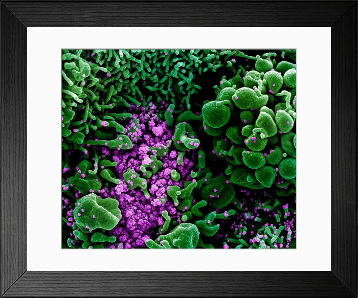 Framed Print : Apoptotic cell (green) heavily infected with SARS-COV-2 virus particles (purple), isolated from a patient sample