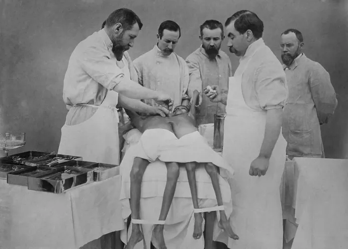 Framed Print : 1912 operation separating young Indian conjoined twin sisters, Radica & Doodica, by famous French surgeon, Eugene-Louis Doyen (1859-1916) is at far left Framed Print : 1912 operation separating young Indian conjoined twin sisters, Radica & Doodica, by famous French surgeon, Eugene-Louis Doyen (1859-1916) is at far left