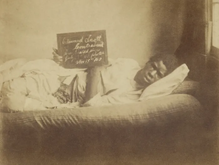 Framed Print : African American, Edward Scott, is photographed in a Union Civil War hospital with an open abdominal wound. The slate describes him as a contraband, on Nov. 15th, 1865 Framed Print : African American, Edward Scott, is photographed in a Union Civil War hospital with an open abdominal wound. The slate describes him as a contraband, on Nov. 15th, 1865