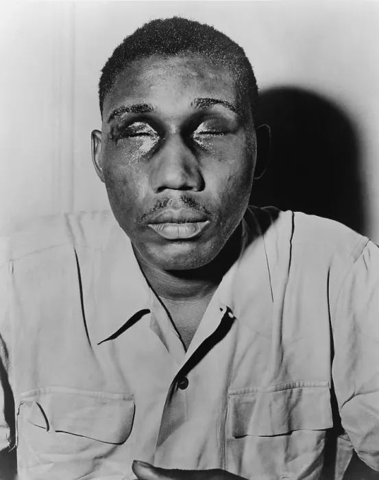 Framed Print : African American man with eyes swollen shut from beating. Ca. 1945-50