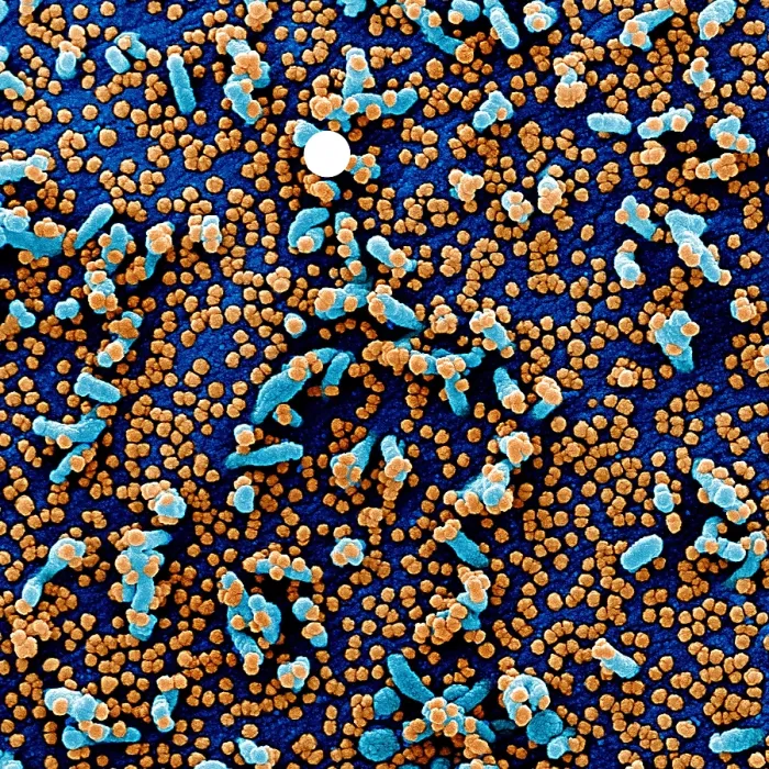 Framed Print : Apoptotic cell (blue) infected with SARS-COV-2 virus particles (red), isolated from a patient sample Framed Print : Apoptotic cell (blue) infected with SARS-COV-2 virus particles (red), isolated from a patient sample