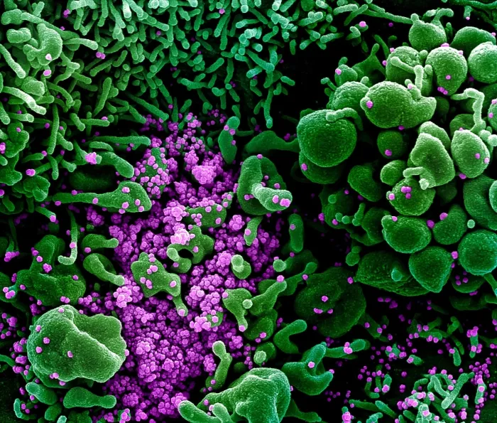 Framed Print : Apoptotic cell (green) heavily infected with SARS-COV-2 virus particles (purple), isolated from a patient sample