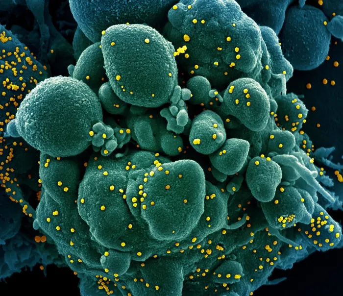 Framed Print : Apoptotic cell (greenish brown) heavily infected with SARS-COV-2 virus particles (pink), isolated from a patient sample